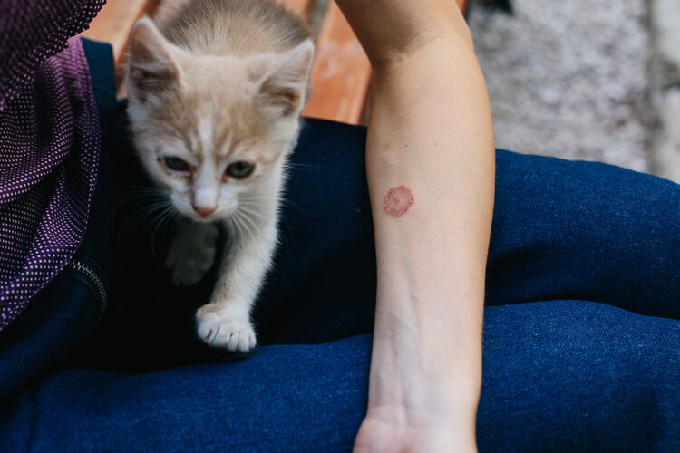 Ringworm zoonosis