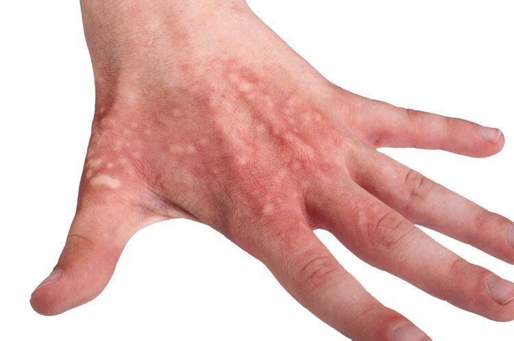 sores on hand